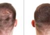 20% off ‘Hair thickening’ fibres ‘great at concealing bald spots’