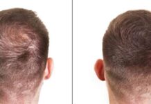 20% off ‘Hair thickening’ fibres ‘great at concealing bald spots’