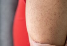 NHS issues advice on ‘chicken skin’ condition