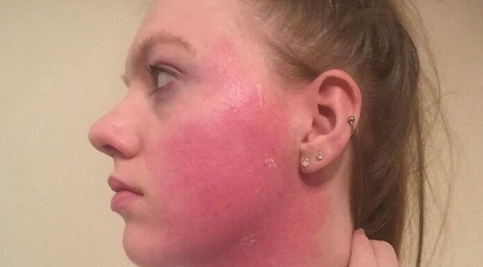 Ex Boots worker ‘wishes she had’ their spot cream to treat acne